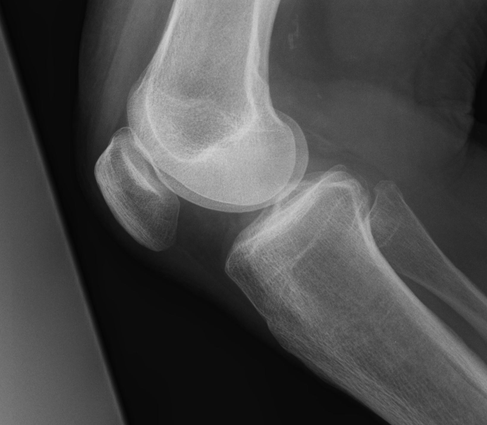 TKR Preop Patella Baja